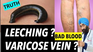 Leech therapy in skin disease in timelapse drpys [upl. by Anihsat605]