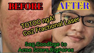 co2 fractional laser  totoo nga sya😍 Honest Review 2021 [upl. by Keenan]