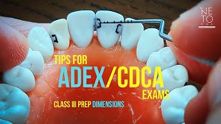 Class III Prep Dimensions size of cavities and parameters [upl. by Shiekh]