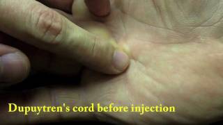 Xiaflex collagenase injection for Dupuytrens Finger Contracture [upl. by Fritz449]