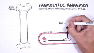 Haemolytic Anaemia  classification intravascular extravascular pathophysiology investigations [upl. by Nyasuh]