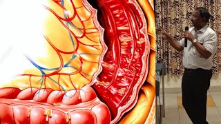 Bacillary Dysentery SHIGELLOSIS [upl. by Sinylg]