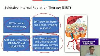 CCMA amp SIO Webinar  Prof David Liu Using SIRT to Extend Embolization Therapy in HCC [upl. by Enois]