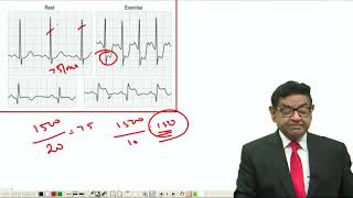 MRCP  Coronary Artery Disease  Lectures by Dr Bhatia [upl. by Piderit]