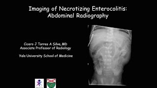 Necrotizing enterocolitis [upl. by Attenauq]