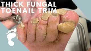 A Thick and Fungal Toenail [upl. by Dub]