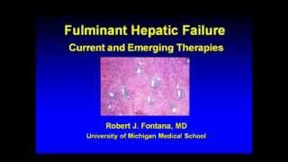 Fulminant Hepatic Failure Current and Emerging Therapies [upl. by Ezekiel]