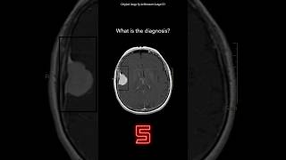 Brain MRI Question 6 [upl. by Areht]