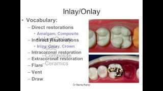 Introduction to inlaysonlays [upl. by Oehsen]