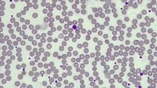 WBC Differential WBCPLT Estimate RBC Morphology [upl. by Enelyt]