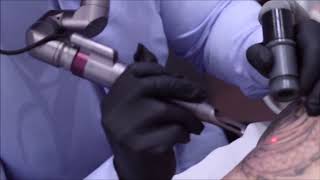 El Mejor laser para eliminar tatuajes 2019 [upl. by Joub]