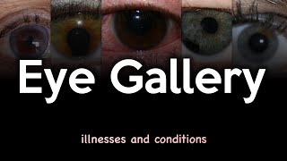 Eye Illnesses and Conditions Image Gallery [upl. by Odelet602]