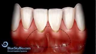 Patient Treatment Videos Free Gingival Graft [upl. by Rubenstein]