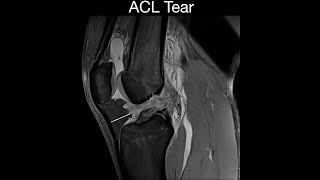 ACL Tear [upl. by Anelehs605]