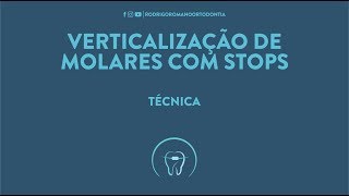 Verticalização de molares com stops  Técnica Ortodôntica [upl. by Bergen625]