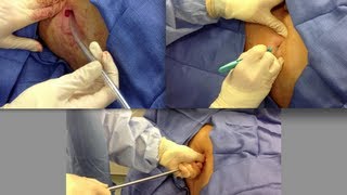 Chest Tube Placement [upl. by Gnet256]