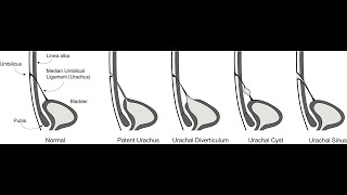 Results of Patent urachus Urachal cyst urachal sinus Diverticulum urachal fistula [upl. by Care]