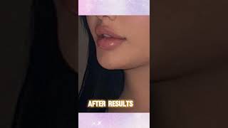 Lip Filler Treatment results in BandraMumbai [upl. by Imiaj]