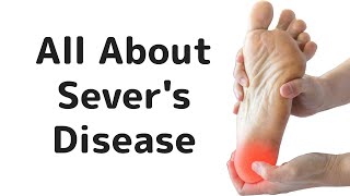 Severs Disease or Calcaneal Apophysitis [upl. by Dnalevelc]