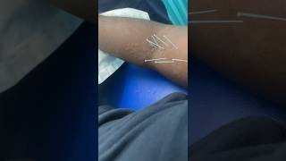 Needling therapy The Nits vlog  youtube youtubeshorts ytshorts therapy gymlife injury [upl. by Naitsirhc]