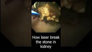 How the Laser Break Kidney stone  Laser Lithotripsy [upl. by Konrad]