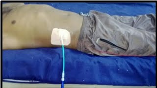 Percutaneous Drainage of amoebic liver abscessPig tail catheter [upl. by Ernestus]