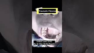 Traumatic Fibroma Laser Treatment  Dr Mae Abella [upl. by Mccullough]