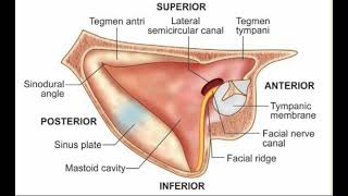 Mastoidectomy [upl. by Ameekahs386]