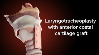 Medical Animation Anterior Cricoid Split  Cincinnati Childrens [upl. by Jezrdna]