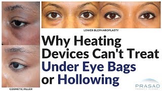 Why Radiofrequency or Laser Devices Cant Treat Under Eye Bags or Hollowing [upl. by Fleda]