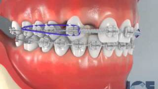 Missing Upper Laterals [upl. by Sergei]