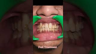 Cleft Palate patient Treatment with Self ligating Braces Dr Abhinav Shrivastava MDS [upl. by Eade]