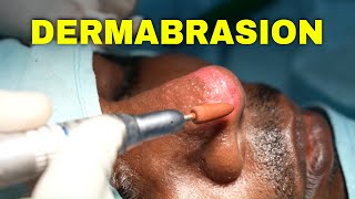 DERMABRASION For Scar Nose  Bad Scar Removed  Dr Sunil Richardson [upl. by Anila]