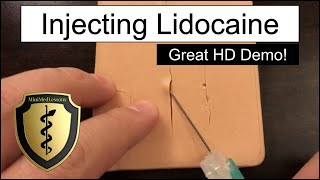 Injecting Lidocaine for a Laceration  HD Video Demonstration [upl. by Emanuel313]