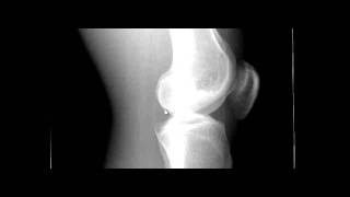 Lateral Knee Xray and Rotation [upl. by Tarsus]