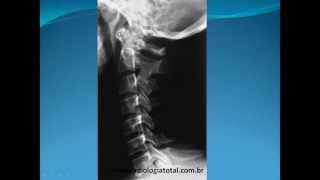 Anatomia Radiológica Coluna Vertebral parte 2 [upl. by Kries]