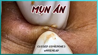 Big Cystic Acne Blackheads Extraction Blackheads amp Milia Whiteheads Removal Pimple Popping [upl. by Noiramaj]