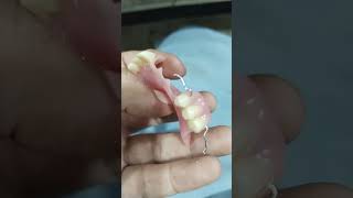 Partial Denture Come for Addition [upl. by Orit498]