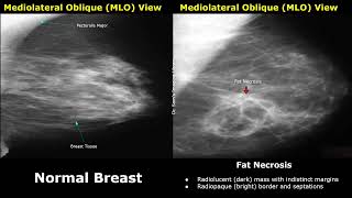 Mammography Normal Vs Abnormal Images  BIRADS Classification  Breast Cancer amp Other Diseases [upl. by Aileda564]