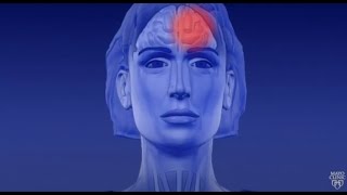 Learn About Migraine Aura [upl. by Okun418]