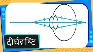 Physics – नेत्र Part 6 – Hypermetropia दीर्घदृष्टि दोष – Hindi [upl. by Karalee]