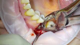 Removal of an Infected Dental Implant [upl. by Anrol351]