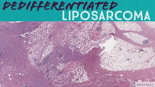 Dedifferentiated liposarcoma with heterologous osteosarcoma component [upl. by Raines91]