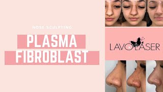 PLASMA FIBROBLAST NOSE SCULPTING VLOG [upl. by Ennaylil]