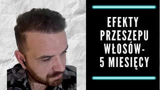 Efekty przeszczepu włosów  5 miesięcy [upl. by Aerdnaeel264]