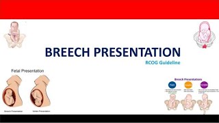 Management of Breech Presentation RCOG Guideline [upl. by Acilef]