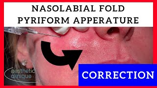 Pyriform Apperature  Nasolabial Folds Correction by Dr Steven Weiner [upl. by Anul412]