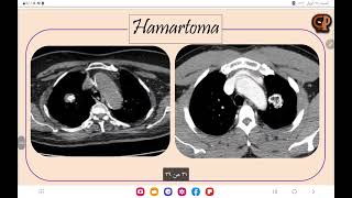 3 Lung Lesions  tuberculoma vs Hamartoma [upl. by Dajma]