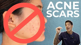 How to get rid of Acne Scars  Dr Davin Lim [upl. by Aicen242]