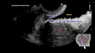 Dynamic transvaginal ultrasound examination for assessing anatomy of parametrium UOGJournal [upl. by Yahsram]